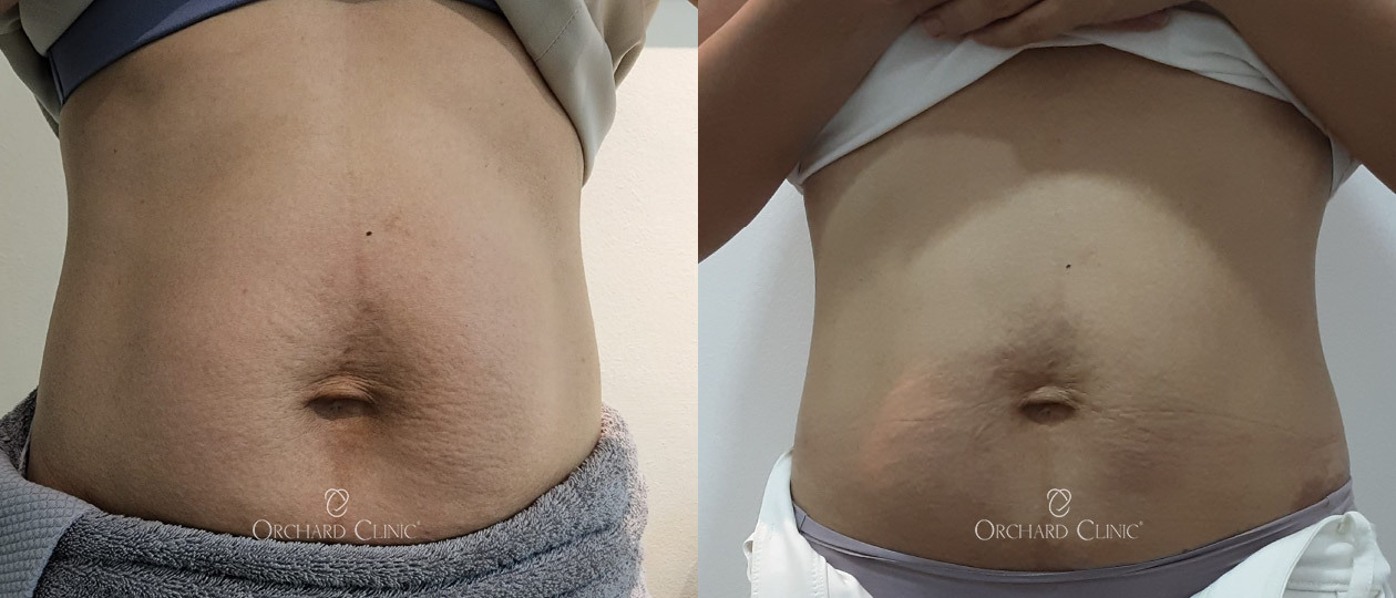Diastasis Recti before and after case 4