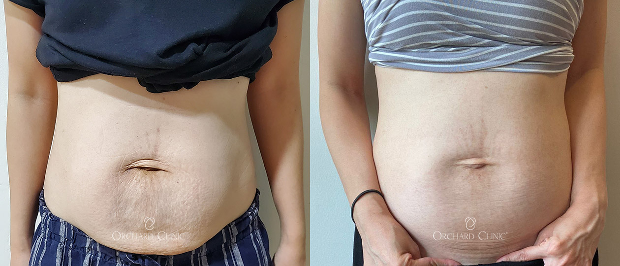 Diastasis Recti before and after case 5
