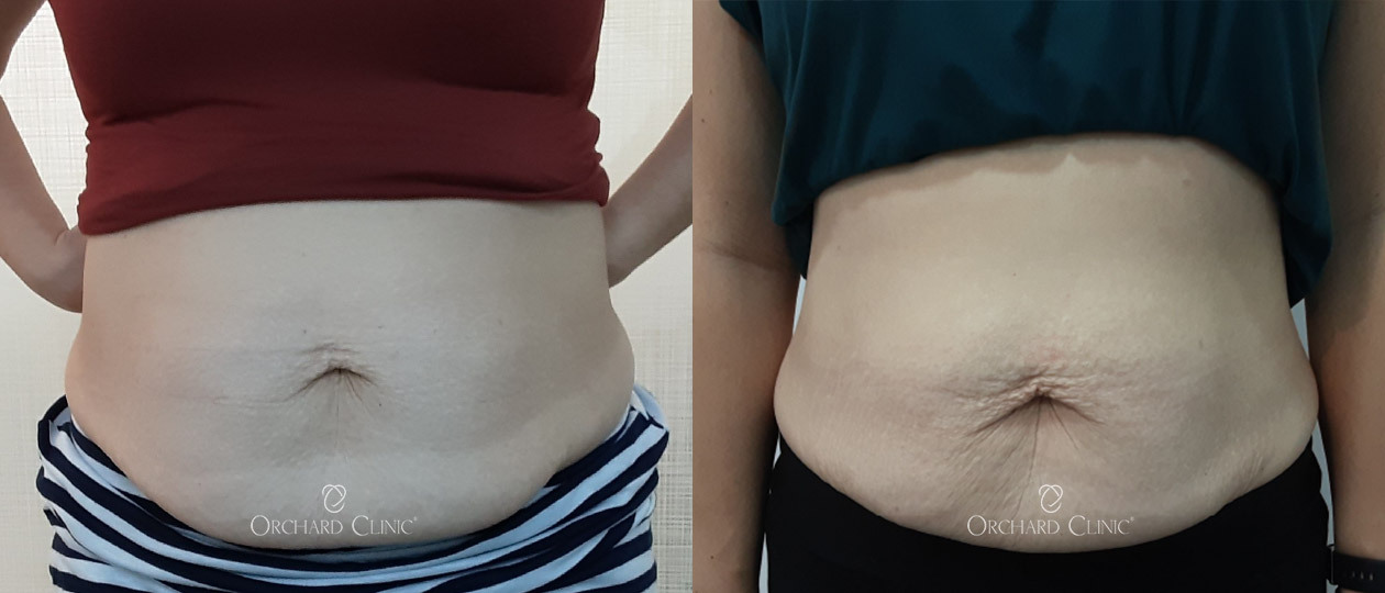 Diastasis Recti before and after case 6